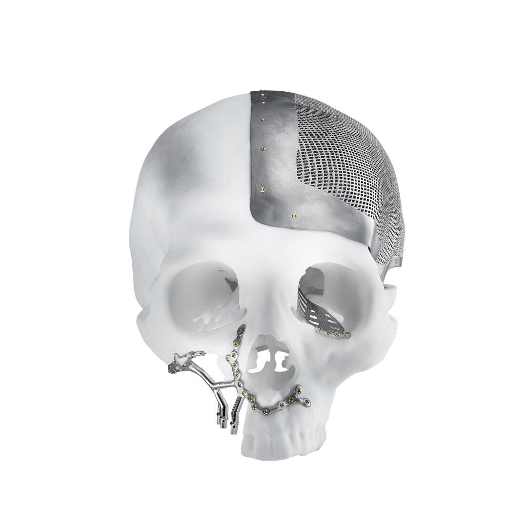 Ein weißes menschliches Schädelmodell mit metallischen Implantaten, darunter eine große Metallgitterplatte, die einen Teil des Schädels bedeckt, und kleinere Metallplatten und Schrauben, die an Kiefer und Wangenknochen befestigt sind.