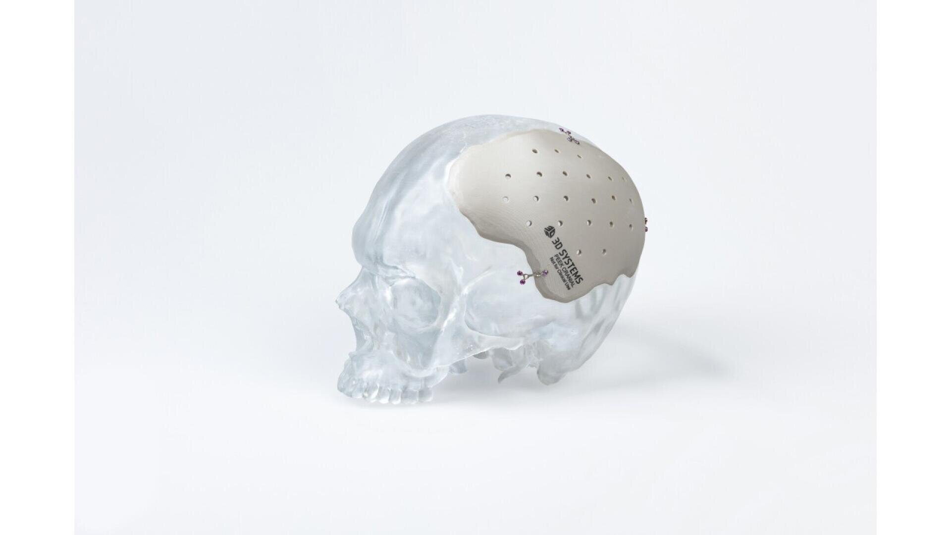 A transparent skull model displays a perforated, light-colored cranial implant labeled “BIOMODEX,” fitted to replace part of the skull’s upper side, shown on a plain white background.